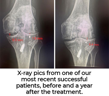 knee pain before and after