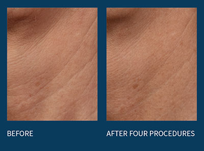 microneedling before and after